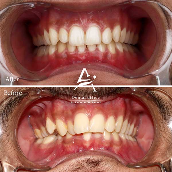 نمونه کار 1 ارتودنسی نامرئی دکتر آرین نژاد