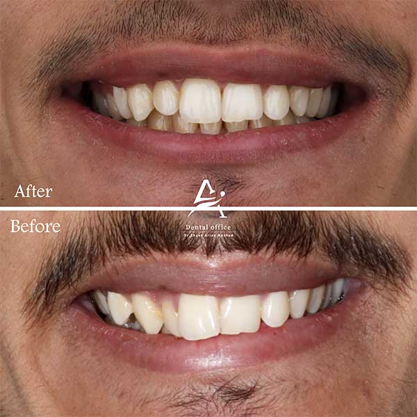 نمونه کار 1 ارتودنسی نامرئی زاویه روبرو توسط دکتر آرین نژاد