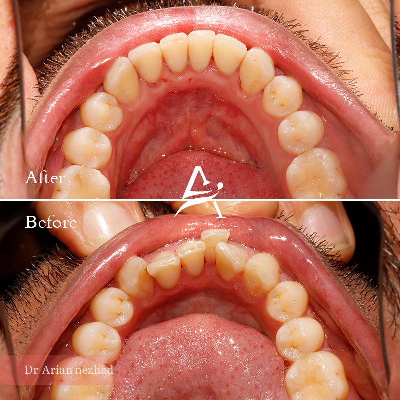 نمونه کار 2 ارتودنسی نامرئی دکتر آرین نژاد عکس فک پایین