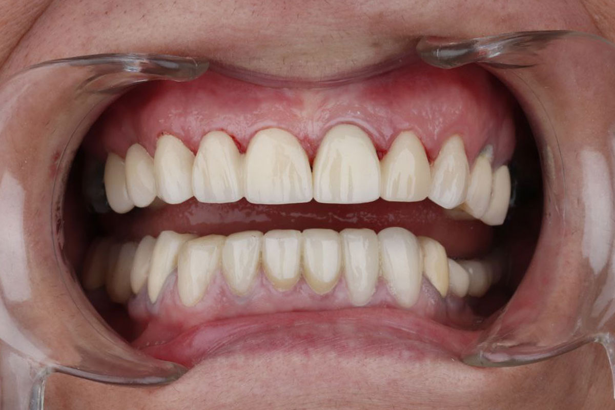 نمونه کار 1 مرحله بعد روکش دندان مرکز دندانپزشکی دکتر آرین نژاد