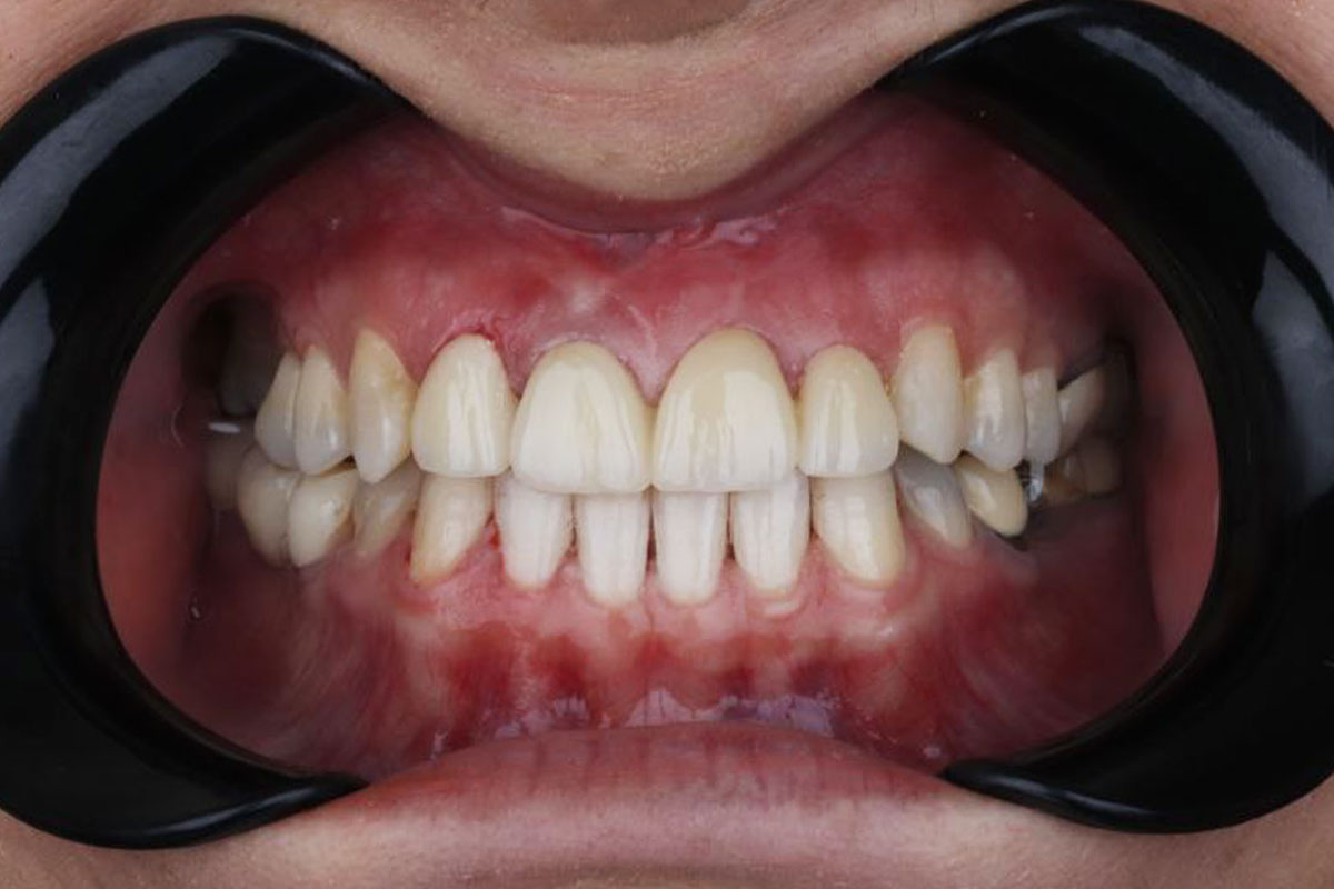 نمونه کار 2 مرحله بعد روکش دندان مرکز دندانپزشکی دکتر آرین نژاد