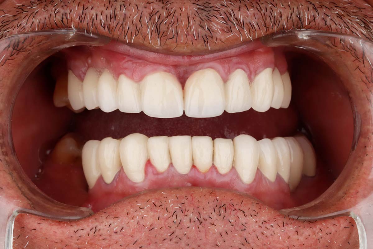 نمونه کار 4 بعد روکش دندان مرکز دندانپزشکی دکتر آرین نژاد