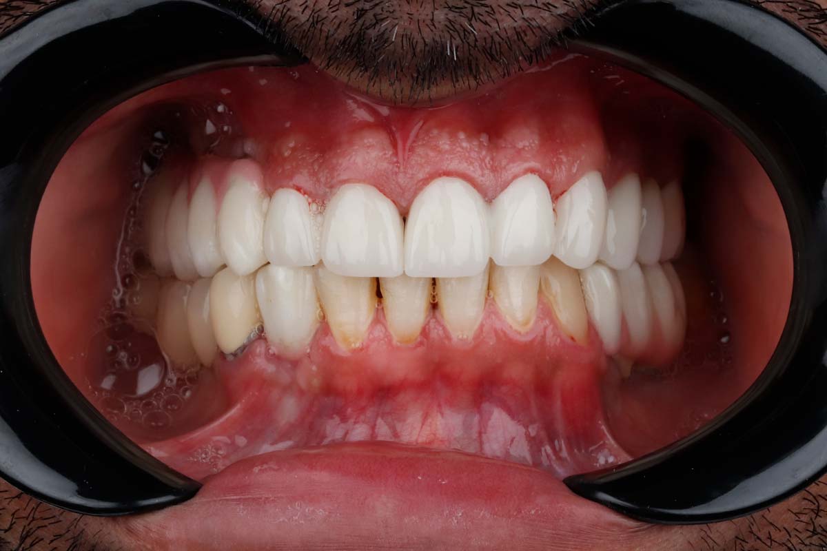 نمونه کار 5 بعد روکش دندان مرکز دندانپزشکی دکتر آرین نژاد