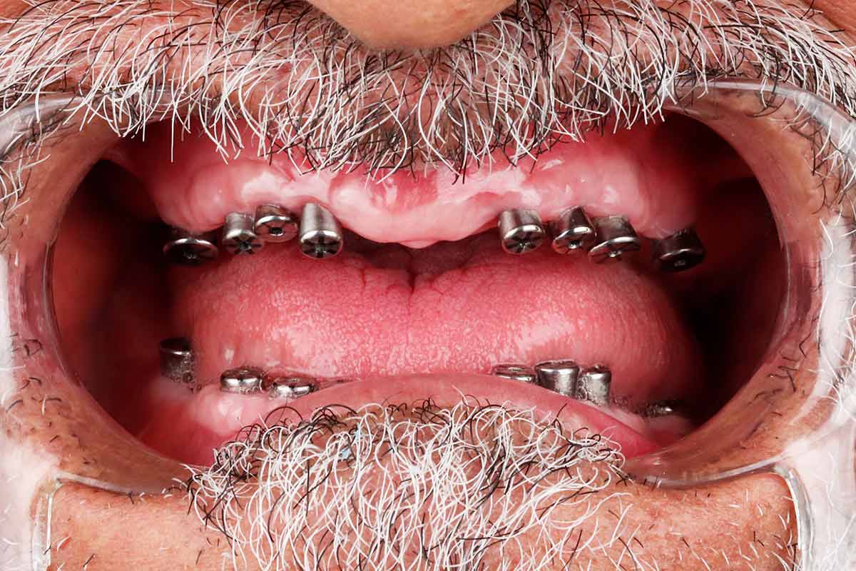 نمونه کار 2 ایمپلنت مرحله قبل روکش مرکز دندانپزشکی دکتر آرین نژاد