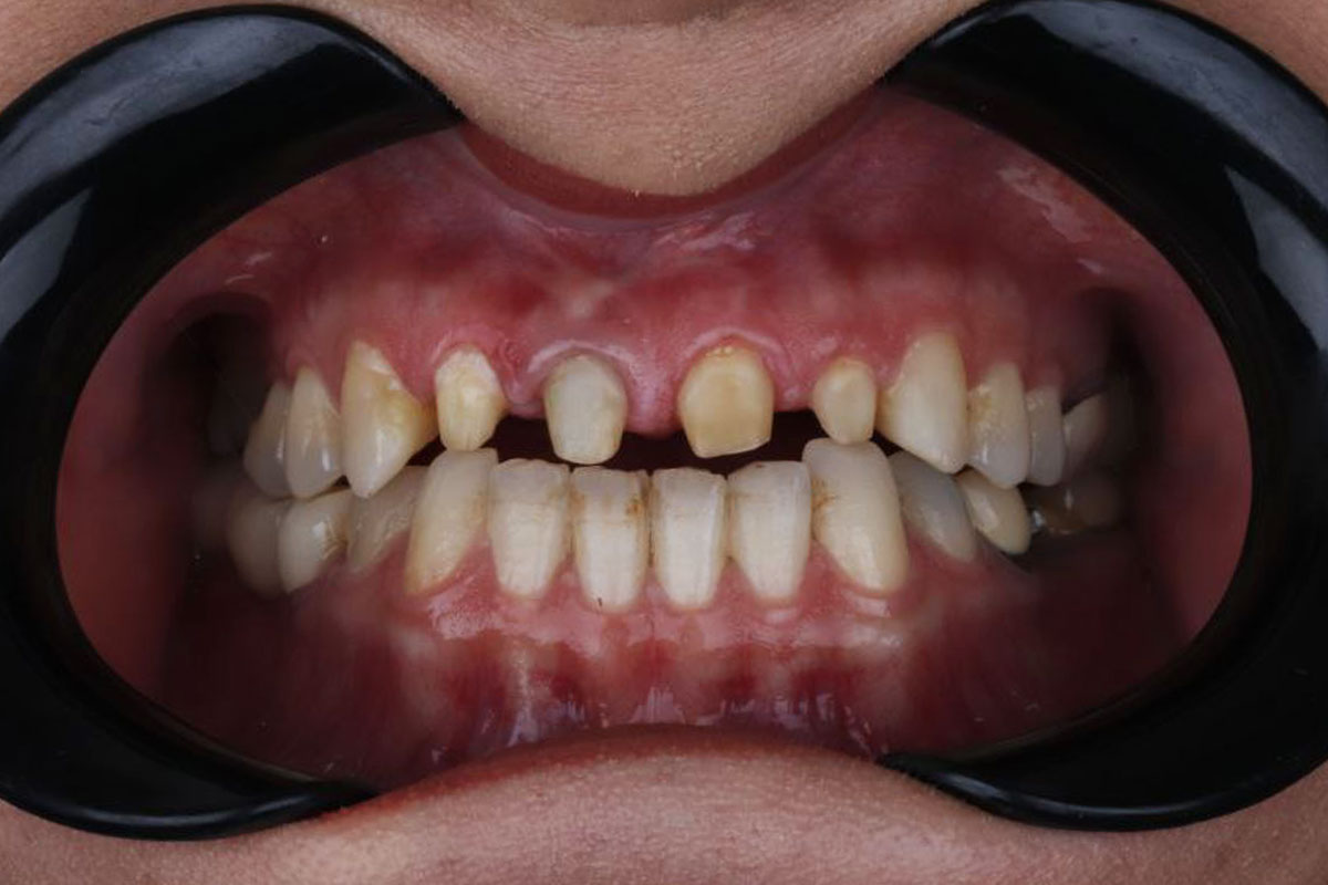 نمونه کار 2 مرحله قبل روکش دندان مرکز دندانپزشکی دکتر آرین نژاد