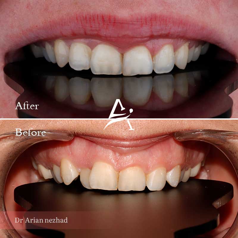 Orthodontic-work-sample-3-by-Dr-Arian-Nejad-upper-jaw-view