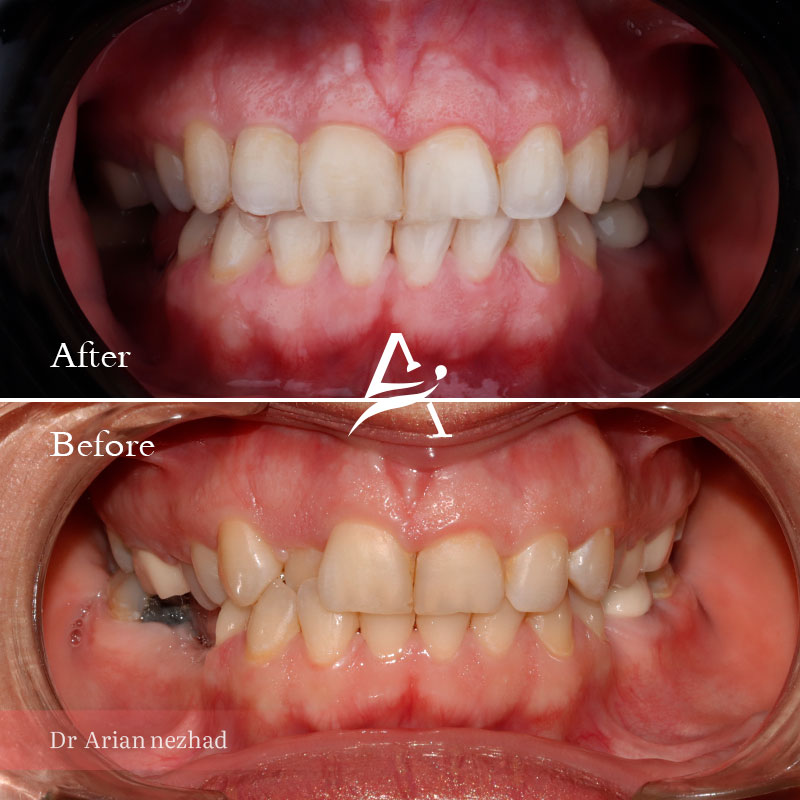 نمونه کار 4 ارتودنسی دکتر آرین نژاد زاویه کلی روبرو
