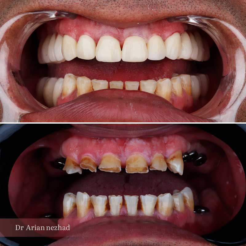 نمونه کار 3 ایمپلنت دندان دکتر آرین نژاد نمای دو فک