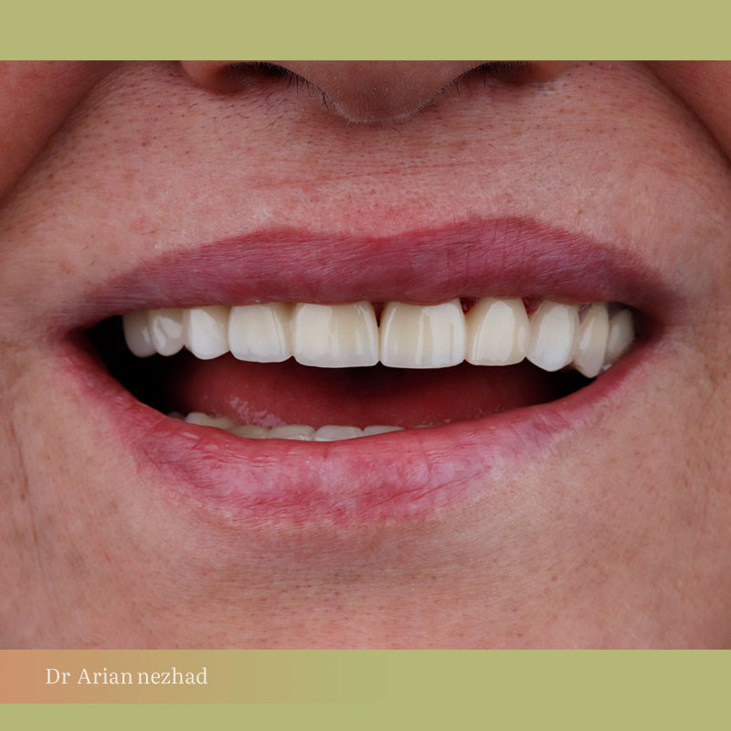 نمونه کار روکش دندان فول فک بالا در پاکدشت